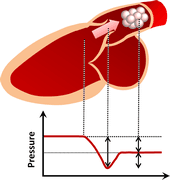 Perte de pression dans la sténose aortique